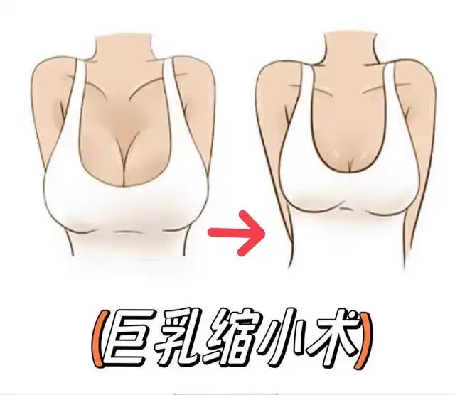 乳房缩小术