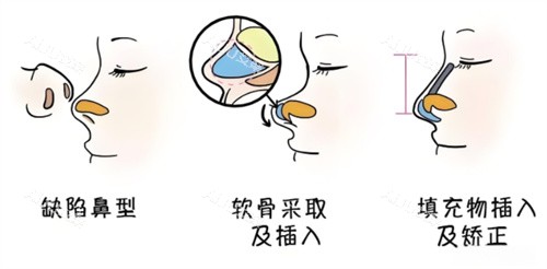 上海韩嘉毅做鼻子口碑怎么样？技术审美双在线，网友分享自然妈生鼻成效！