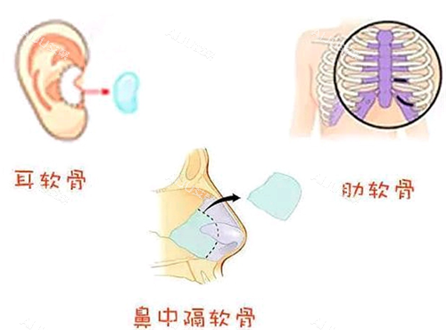 隆鼻手术