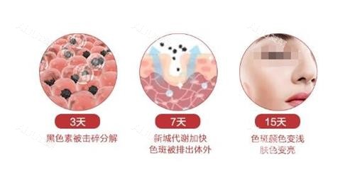 点阵激光的***过程 点阵激光的***过程