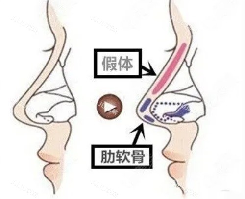 上海王旭东和黄烈文do鼻哪个好？深度对比二位审美细节+剥离技术&术后防包挛缩