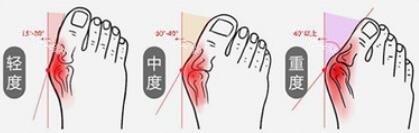 拇外翻找温建民还是李昕宇?从核心技术与治疗哲学切入,为你剖析两位医生的专长分野