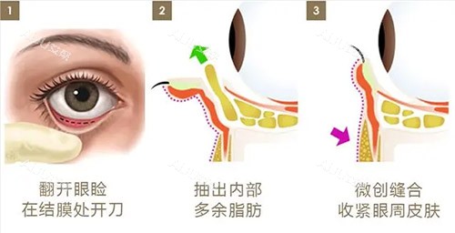 合肥桑鹏飞和王佳妮哪个做眼袋好？看老粉无回缩反馈，点击Very美学小程序快捷留电免排队