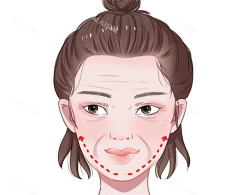 面部抗衰提升卡通图