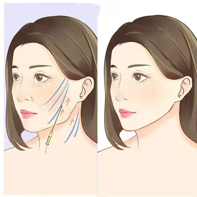 拉皮除皱手术.webp