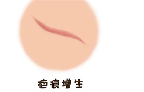 解析：十几年的凹陷疤痕可以修复吗？是可以的，填充/激光/手术治疗方式都可以