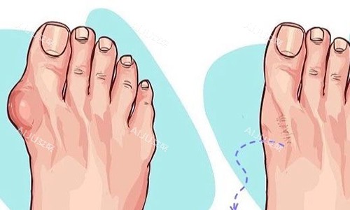 大脚骨手术前后对比图 大脚骨手术前后对比图
