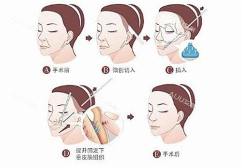 拉皮手术过程 拉皮手术过程