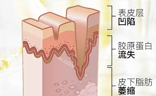 皮肤皱纹皮下组织剖面图 皮肤皱纹皮下组织剖面图