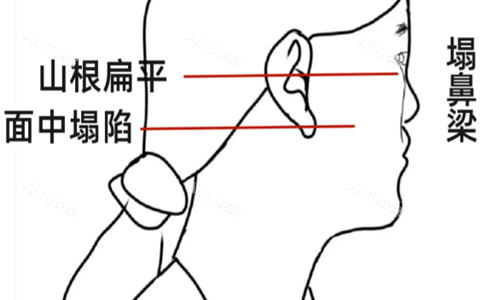 扁平脸示意图 扁平脸示意图