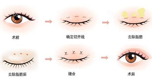 双眼皮术前术后示意图 双眼皮术前术后示意图