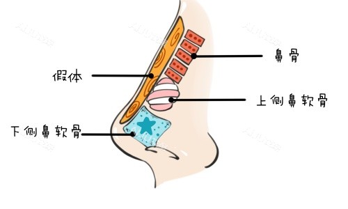 假体垫鼻示意图 假体垫鼻示意图