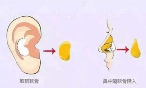 自体软骨垫鼻示意图 自体软骨垫鼻示意图