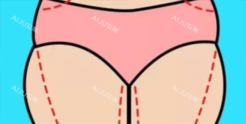 大腿吸脂术前画线展示图 大腿吸脂术前画线展示图