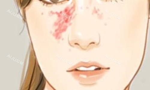胎记示意图