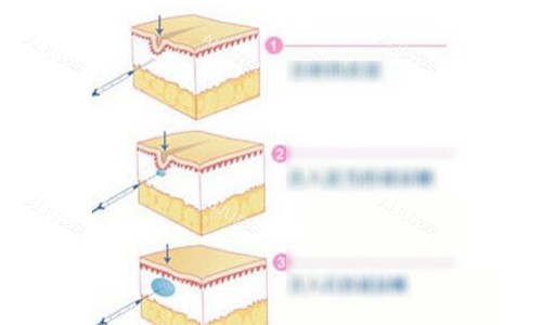 玻尿酸注射图解动画示意图