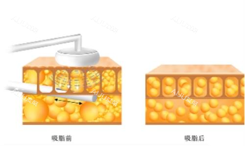 吸脂前后对比图 吸脂前后对比图