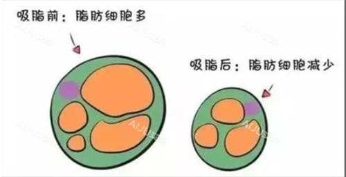 吸脂前后动画图示 吸脂前后动画图示