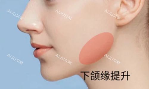 方圆脸下颌缘示意图 方圆脸下颌缘示意图