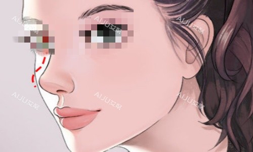 隆鼻示意图 隆鼻示意图