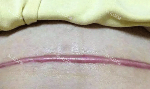 干货！疤痕增生是什么样子的？深入解析疤痕增生的形态与特性，以及疤痕增生的分类_艾聚网