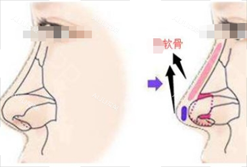 鼻小柱垫软骨侧面透视图