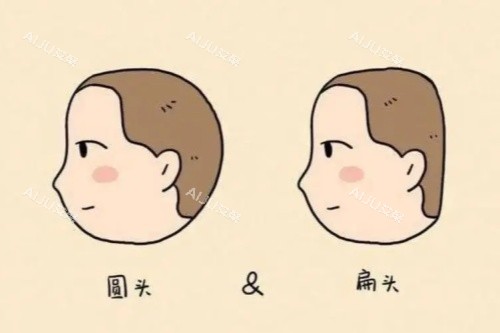 扁头变圆头手术风险大吗?多少钱?参考2024价格表及风险程度_艾聚网