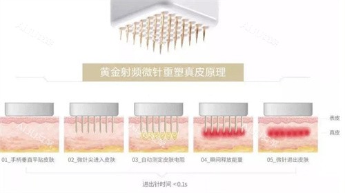 好奇滚针是什么?深挖滚针美容的原理、作用和功效及操作方法_艾聚网