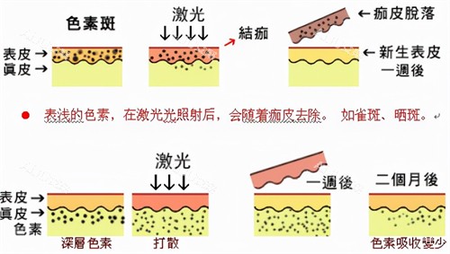 激光祛斑反黑多久能修复正常皮肤？通常需要1~3个月，附反黑原因/修复措施给你！