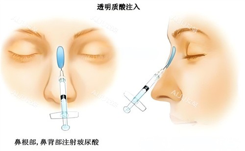 南宁做鼻子多少钱？揭晓南宁做假体隆鼻/自体隆鼻/注射隆鼻/鼻修复等详细价格表