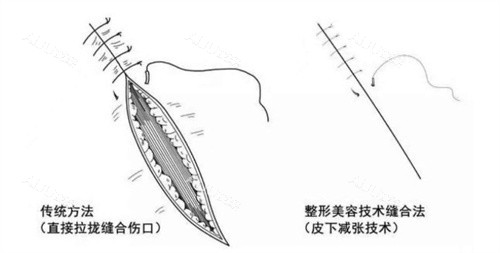 【2025祛疤减张缝合价目表】5000元起！疤痕类型/长度/深度如何影响最终费用？附案例图_艾聚网