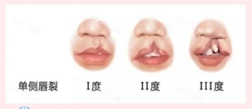 兔唇和唇腭裂的区别在哪?3分钟看懂区别|修复难度/治疗费用/更佳手术时间_艾聚网