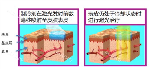 595染料激光原理 595染料激光原理