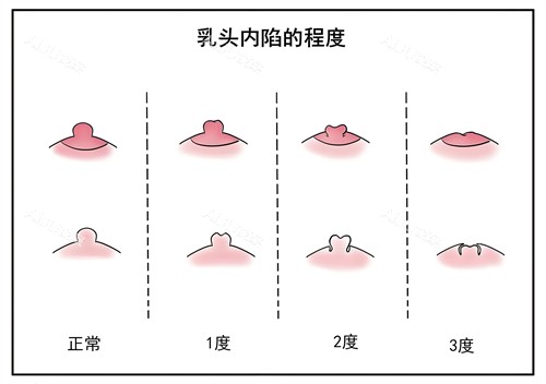 先天乳头内陷是正常的吗？并不正常！根据程度选择适当矫正方法~艾聚网 