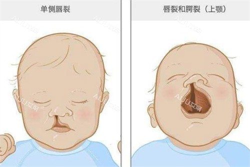 兔唇单侧唇裂 兔唇单侧唇裂