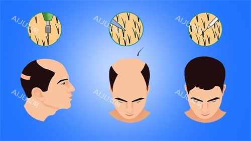 男性毛发移植对比动画图 男性毛发移植对比动画图