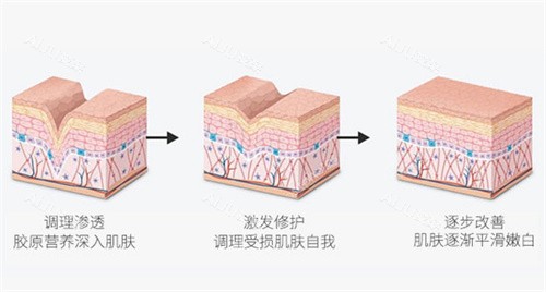 III型胶原蛋白填充原理 III型胶原蛋白填充原理