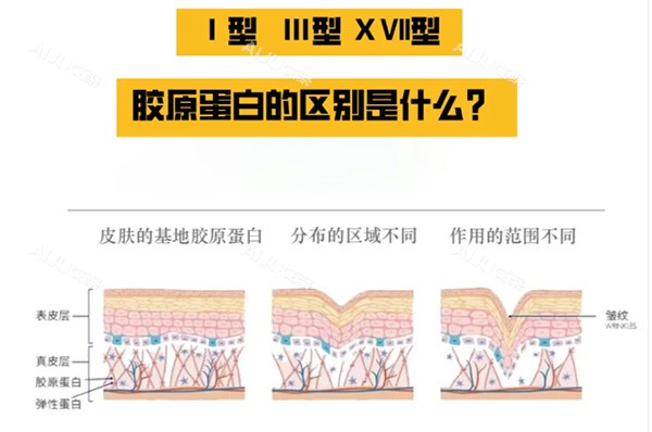 妮凯丽胶原蛋白是日本三型胶原蛋白!有正规的批文,填充凹陷成效好|刺激胶原再生_艾聚网