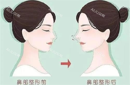 南京米兰柏羽液态隆鼻前后的区别 南京米兰柏羽液态隆鼻前后的区别