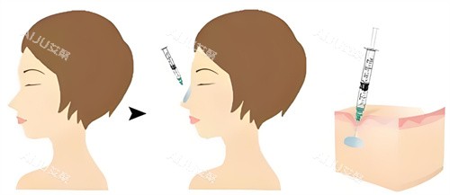 南京米兰柏羽隆鼻玻尿酸原理 南京米兰柏羽隆鼻玻尿酸原理