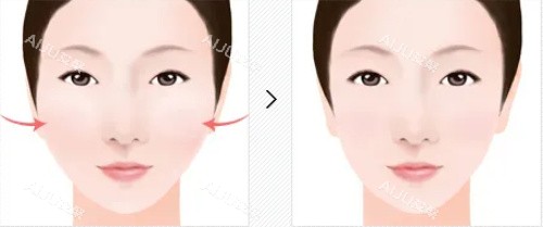 颧骨整形对比图 颧骨整形对比图