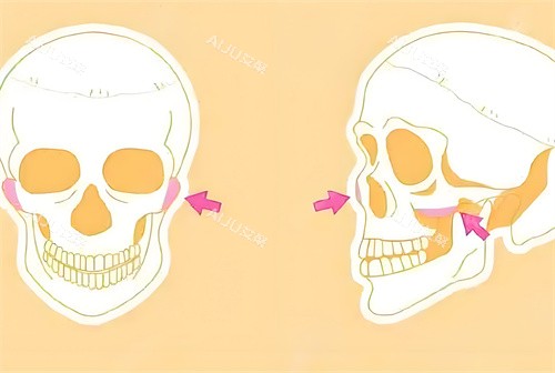 颧骨手术磨骨部位骨头演示动画图 颧骨手术磨骨部位骨头演示动画图