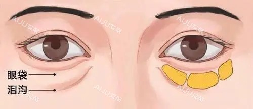 眶隔释放是怎么做的？可以维持多久？解析其原理、价格及优缺点_艾聚网