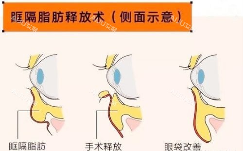 眶隔释放是怎么做的？可以维持多久？解析其原理、价格及优缺点_艾聚网