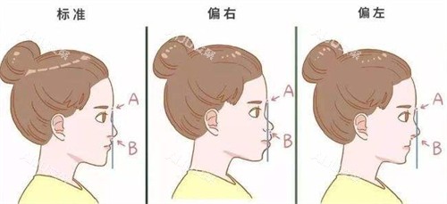 鼻基底不同情况 鼻基底不同情况