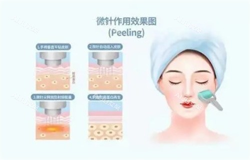 做伊诺思黄金微针多少钱一次？成效好不好？单次3000元起/改善面部多种情况