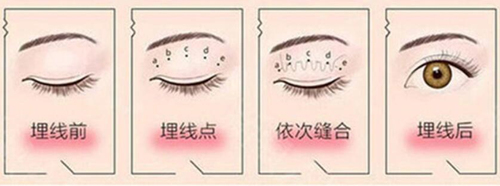2025徐文云眼修复收费明细公开：过宽/过窄2.6w+多次修复失败4.5w+KISS妈生眼修复3.8w+