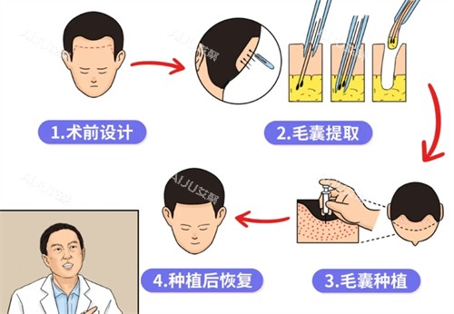 福州植发一般多少钱？公布25年福州做发际线/头顶加密/眉毛/疤痕种植等价格