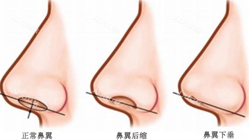 2025济南隆鼻整形手术价目表：缩鼻翼/鼻修复/假体隆鼻/自体隆鼻等费用明细！