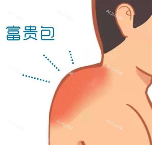 温州富贵包消除术大概多少钱？吸脂5000+切除1.5w+综合手术2w+不同医院收费也有细微差异